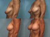 Breast Implants