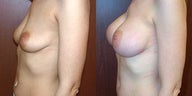 Breast Implants