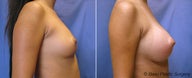Breast Implants