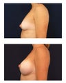Breast Implants