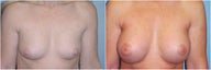 Breast augmentation