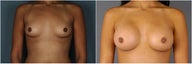 Breast Implants