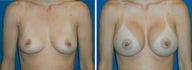 Breast Implants