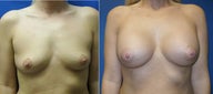 Breast Implants