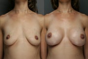 Primary Breast Augmentation