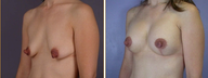 Breast Implants