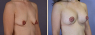 Breast Implants