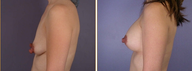 Breast Implants