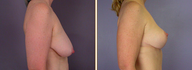 Breast Implants