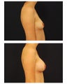 Breast Augmentation