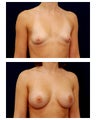 Breast Augmentation