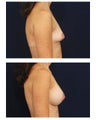 Breast Augmentation