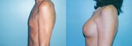 Sub-Muscular Smooth Saline Implants