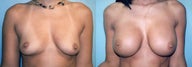 Large Breast Implants (450cc), Post-Pregnancy