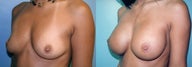 Large Breast Implants (450cc), Post-Pregnancy
