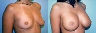 Large Breast Implants (450cc), Post-Pregnancy