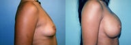 Large Breast Implants (450cc), Post-Pregnancy