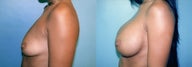 Large Breast Implants (450cc), Post-Pregnancy