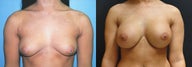 Large Breast Augmentation, 500cc Silicone Implants