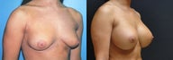 Large Breast Augmentation, 500cc Silicone Implants