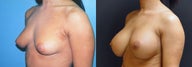 Large Breast Augmentation, 500cc Silicone Implants