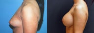 Large Breast Augmentation, 500cc Silicone Implants
