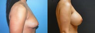 Large Breast Augmentation, 500cc Silicone Implants