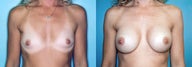 Breast Augmentation (34A to 34C)