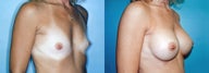 Breast Augmentation (34A to 34C)