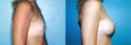 Breast Augmentation (34A to 34C)