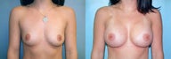 Breast Augmentation