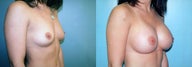 Breast Augmentation