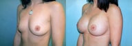 Breast Augmentation