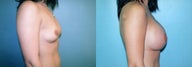 Breast Augmentation