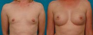 Breast Implants