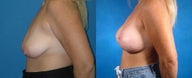 Breast Lift