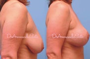 Breast Lift