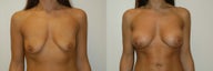 Breast lift with augmentation