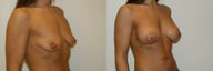 Breast Lift