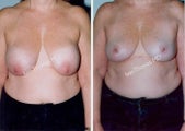 Implant removal and Breast lift