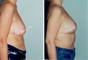 Mastopexy-Breast Lift