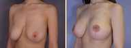 Mastopexy, Breast Lift