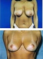 Mastopexy (breastlift) front view
