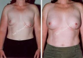 Breast Reconstruction