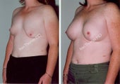 Breast Reconstruction