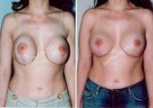 Breast Reconstruction