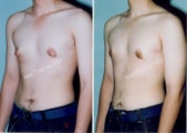Male Breast reduction-Gynecomastia
