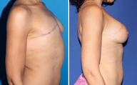 Breast Reconstruction
