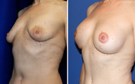 DIEP Instant Implant Breast Reconstruction