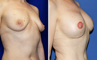 DIEP Instant Implant Breast Reconstruction